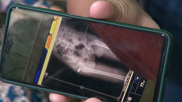 Bocah 7 Tahun Jadi Korban Peluru Nyasar di Gorontalo