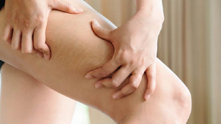 5 Buah Ini Bantu Mencegah Strech Mark di Kulit