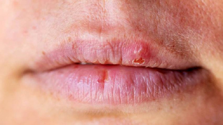 4 Cara Ampuh Cegah Bibir Kering saat Puasa