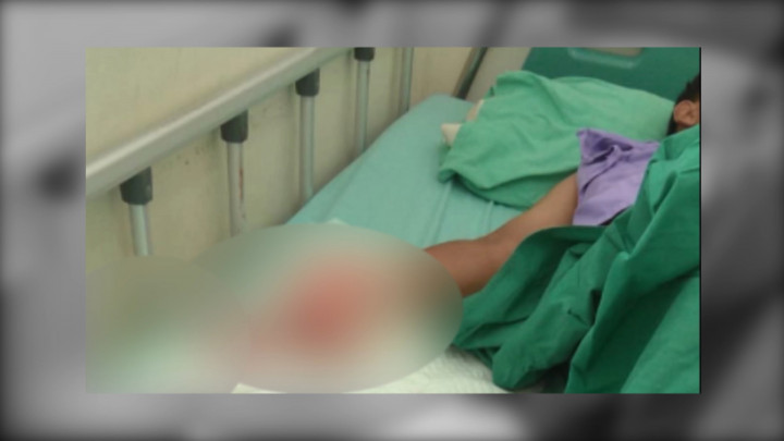 Terkena Ledakan Petasan, Remaja di Ponogoro Kehilangan 3 Jari