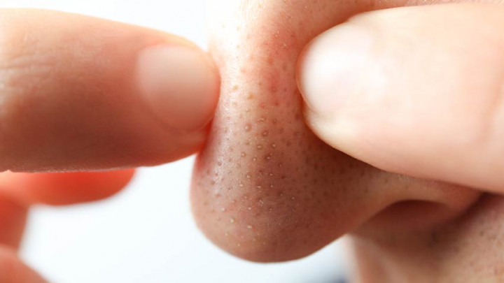 Mudah! Kiat Hilangkan Komedo Membandel Secara Alami