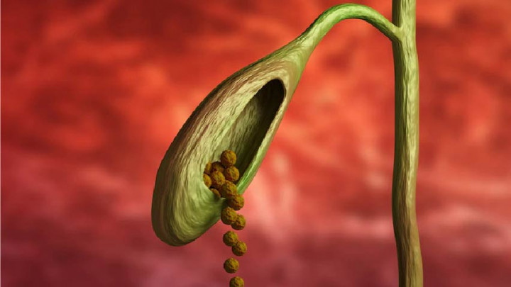 Gejala, Penyebab dan Cara Mengobati Batu Empedu