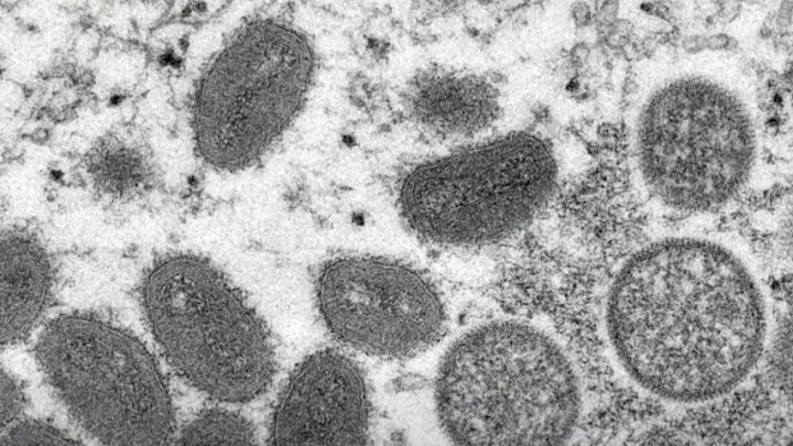 Begini Awal Mula Munculnya Penyakit Cacar Monyet