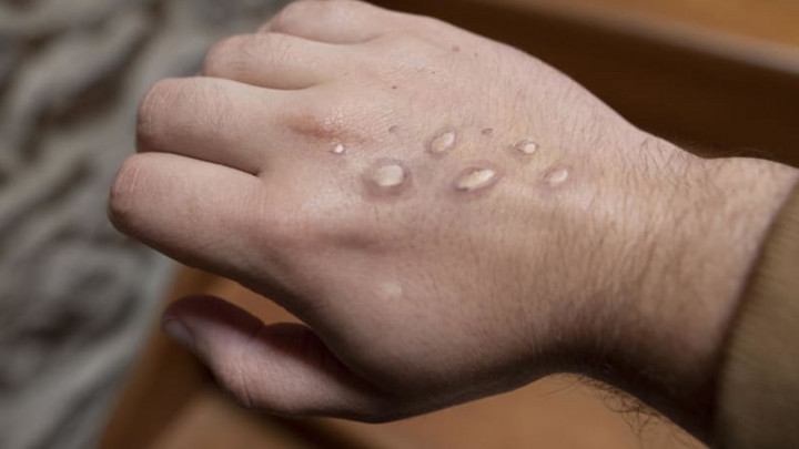 Hasil Tes PCR Pasien Suspek Cacar Monyet Negatif, Ganjar: Masyarakat Harus Tetap Waspada