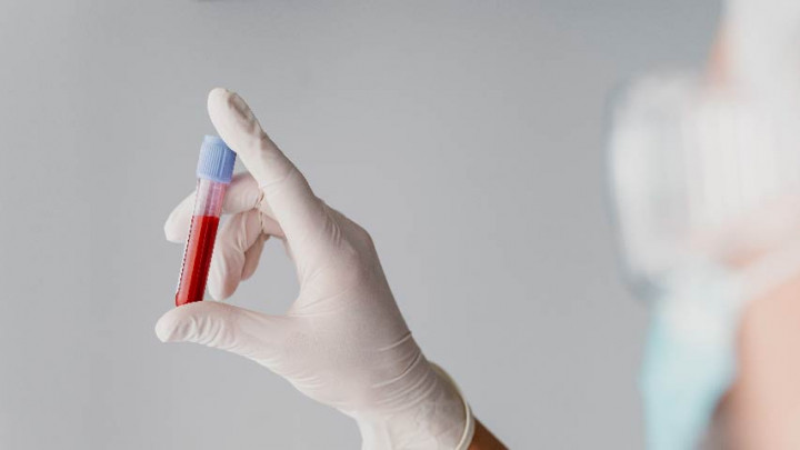 Tips Simpel Menurunkan Lemak Darah Tanpa Obat-obatan