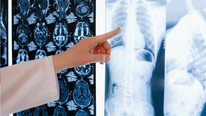 Wow! Ribuan Balita di Surabaya Terpapar Pneumonia