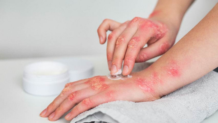 Jangan Disepelekan, 7 Tanda Peringatan Diabetes yang Muncul di Kulit