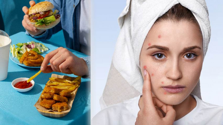 Sebaiknya Hindari 6 Jenis Makanan yang Dapat Memicu Timbulnya Jerawat