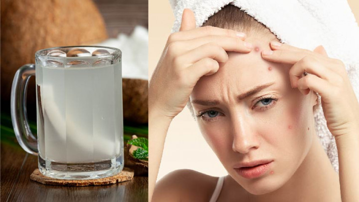 Jenis Makanan yang Bantu Kurangi Jerawat pada Kulit Wajah Berminyak