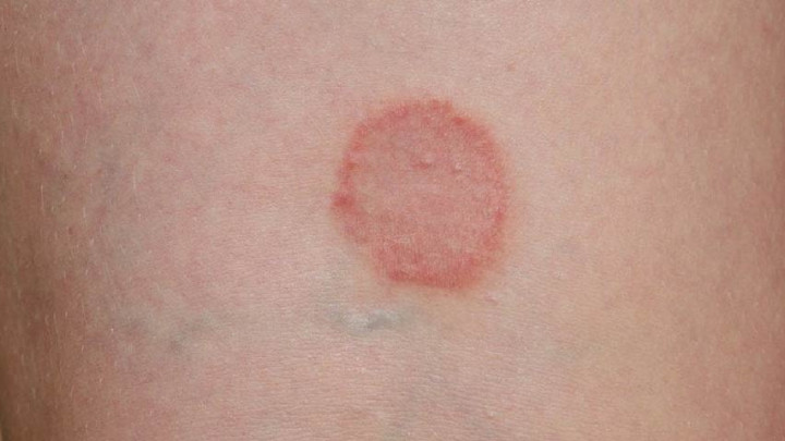 Ringworm, Infeksi Jamur Kucing yang Menyerang Kulit Manusia