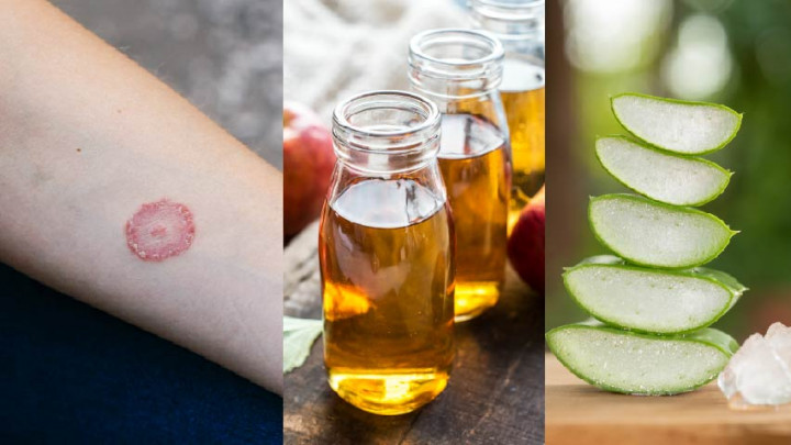 Bahan Alami untuk Mengatasi Gatal Akibat Jamur Ringworm