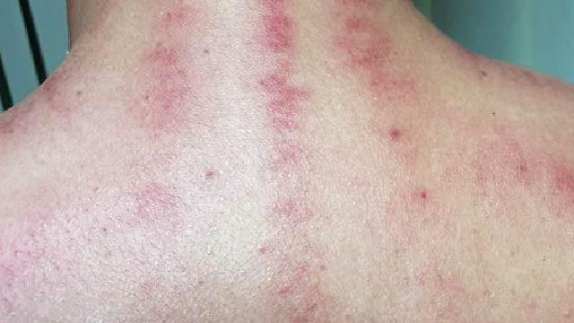 Selain Usir Masuk Angin, Ini 5 Manfaat Lain dari Kerokan