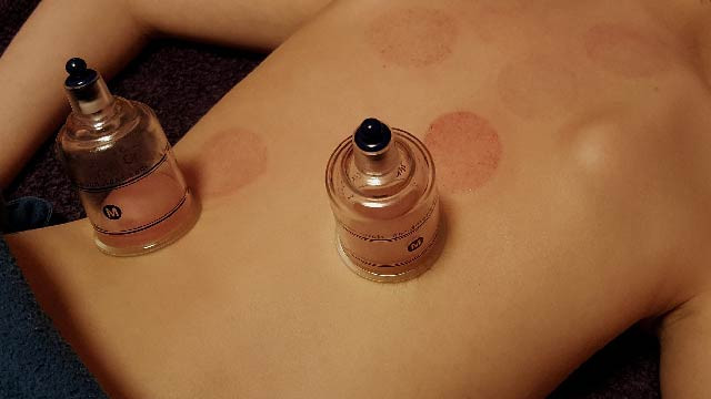 Manfaat Terapi Bekam, Pengobatan Tradisional yang Kian Diminati