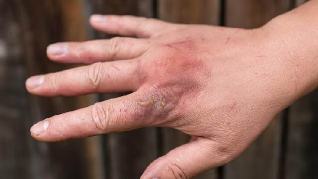 6 Cara Tepat Mengobati Luka Bakar Sendiri di Rumah