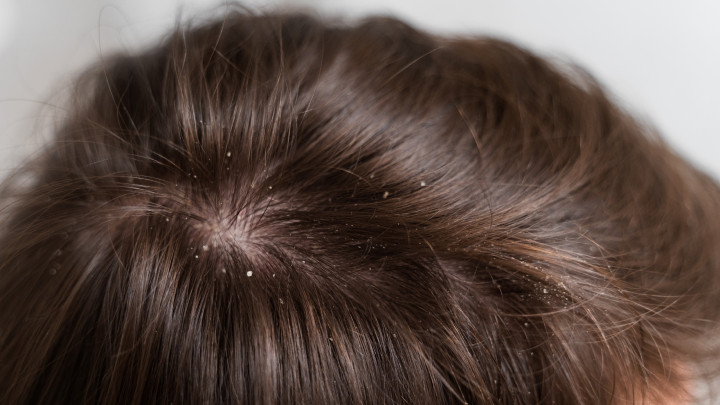 3 Makanan yang Dianggap Ampuh Menghilangkan Ketombe