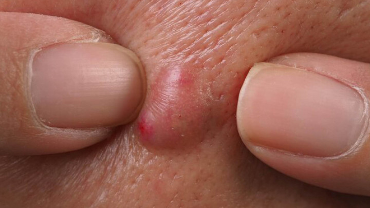 Ini 5 Cara Mengatasi Jerawat di Bokong yang Mengganggu