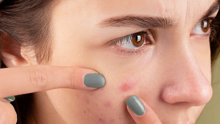 5 Kebiasaan yang Dilakukaan Saat Berjerawat Beserta Solusinya