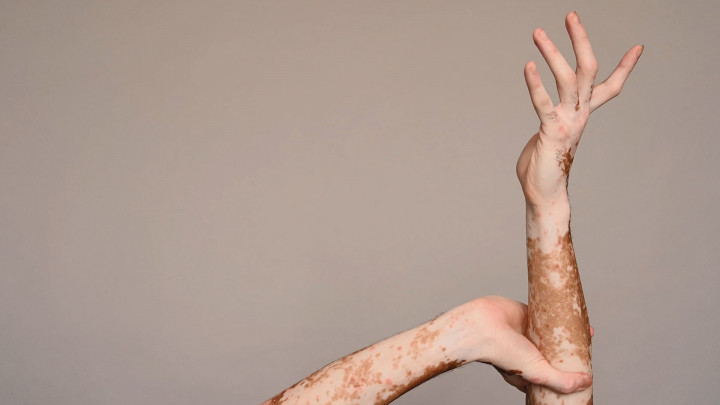 Mengenal Vitiligo, Kondisi Ketika Warna Kulitmu Memudar