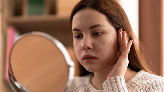 Awas! 3 Kesalahan Menutupi Jerawat saat Makeup, Segera Hindari!