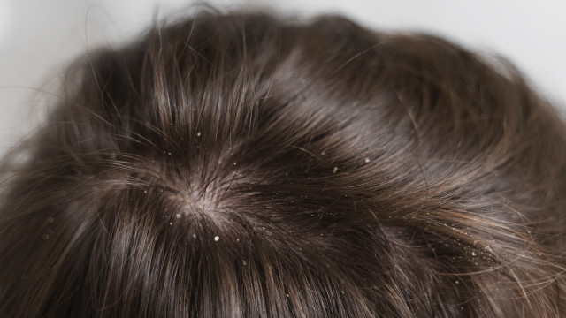 Bisa di Coba Nih! 3 Bahan Sederhana untuk Atasi Kutu Rambut!