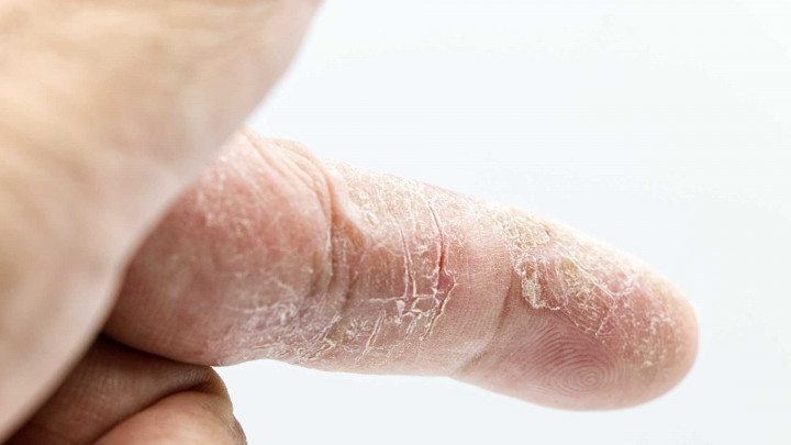 Kulit Kering Suka Mengelupas? Pakai 7 Bahan Alami Ini