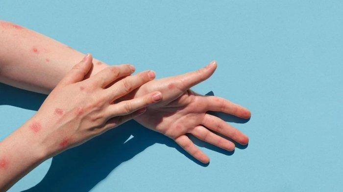 Wabah Mpox Jadi Darurat Kesehatan Global, Kenali 5 Cara Penularannya