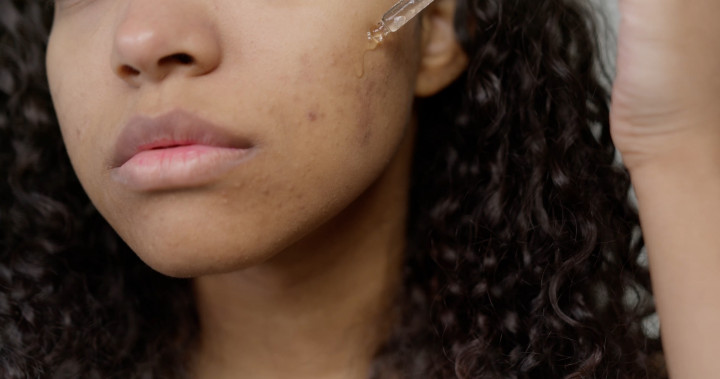 Enggak Pakai Lama, 6 Bahan Alami Ini Bisa 'Usir' Jerawat