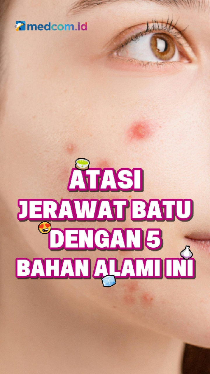 Atasi Jerawat Batu dengan 5 Bahan Alami Ini