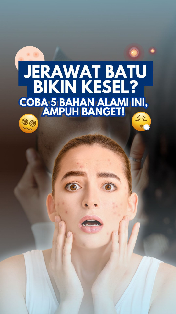 Jerawat Batu Bikin Kesel? Coba 5 Bahan Alami Ini, Ampuh Banget!