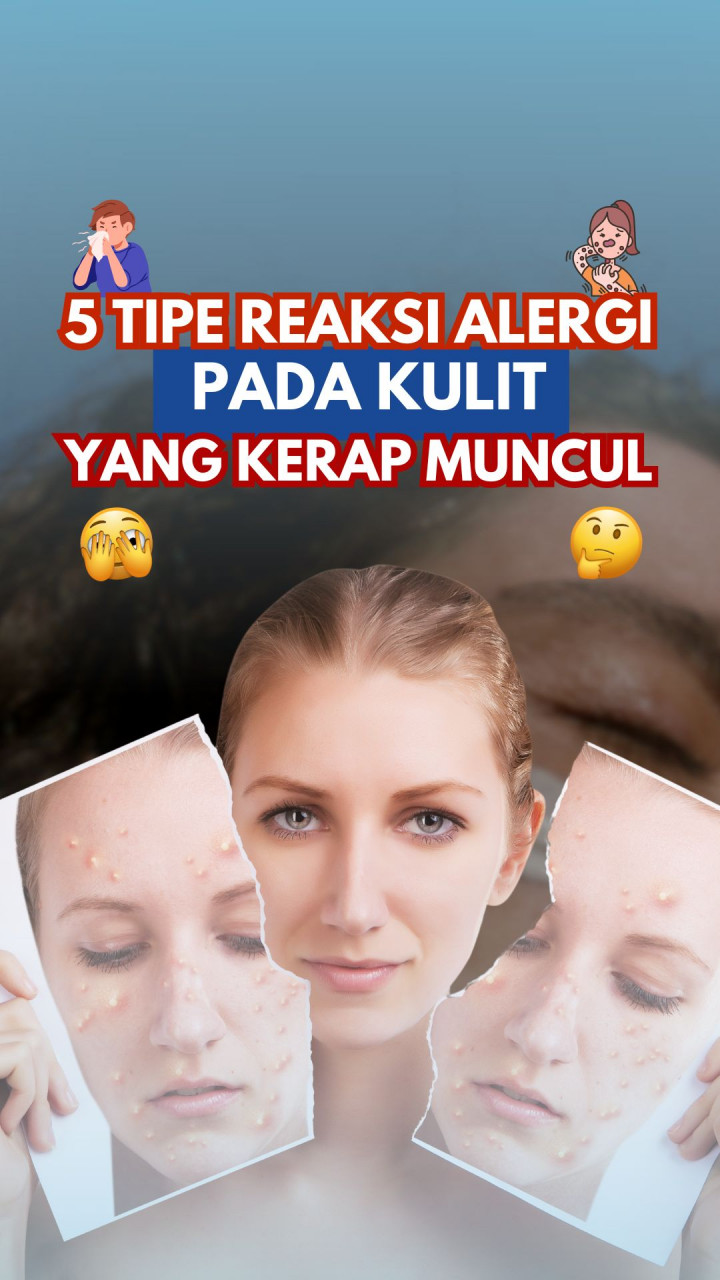 5 Tipe Reaksi Alergi pada Kulit yang Kerap Muncul