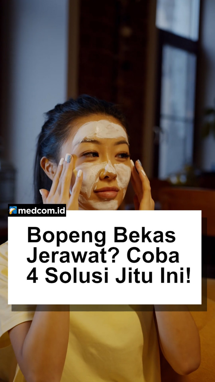 Bopeng Bekas Jerawat? Coba 4 Solusi Jitu Ini!
