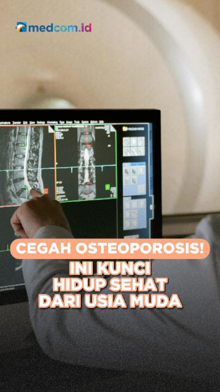 Cegah Osteoporosis! Ini Kunci Hidup Sehat dari Usia Muda