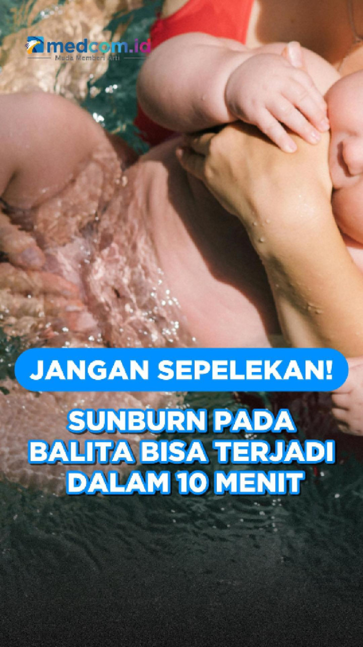 Jangan Sepelekan! Sunburn pada Balita Bisa Terjadi dalam 10 Menit