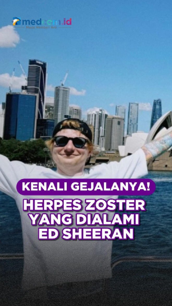 Kenali Gejalanya! Herpes Zoster yang Dialami Ed Sheeran