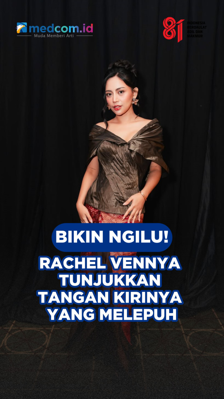 Bikin Ngilu! Rachel Vennya Tunjukkan Tangan Kirinya yang Melepuh