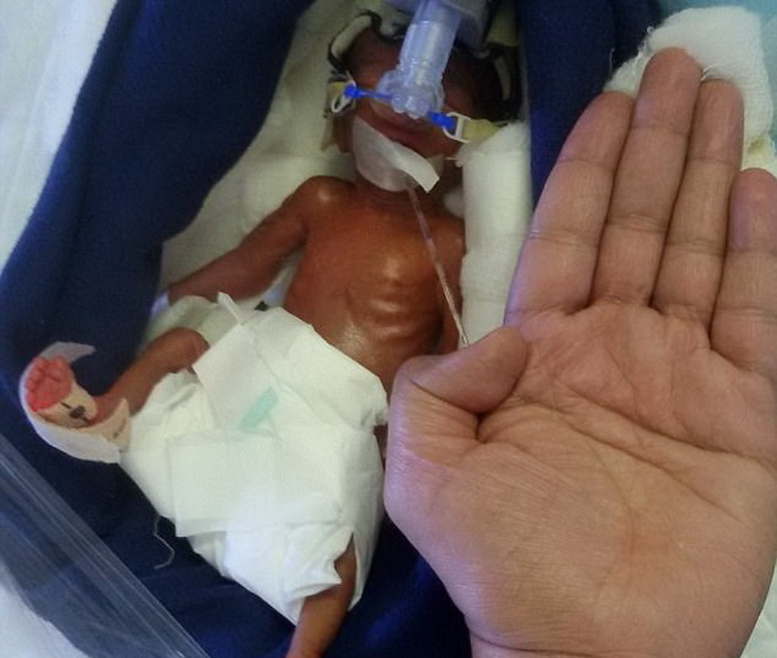 Perjuangan Bayi Terkecil di Asia untuk Bertahan Hidup