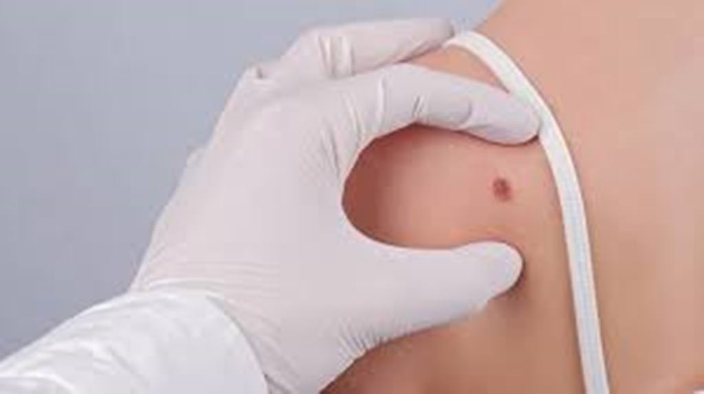 Melanoma, Kanker Ganas yang Mengancam Nyawa