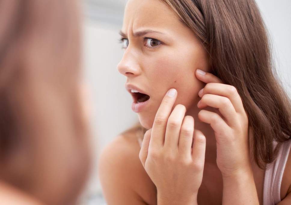 Tips Hilangkan Bekas Jerawat