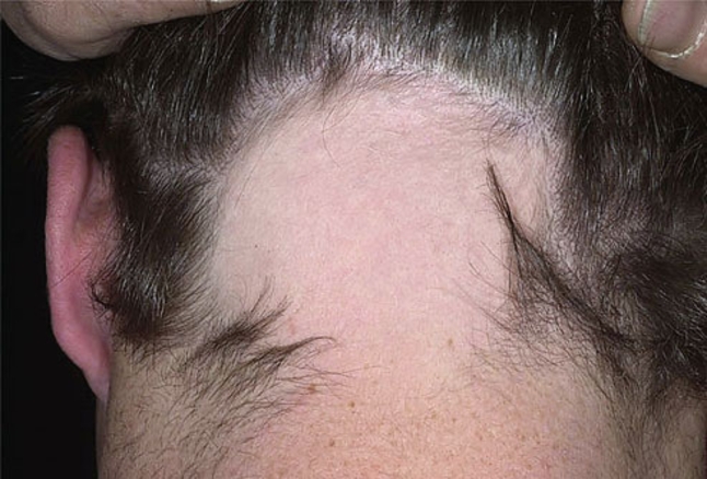 Apa itu alopecia