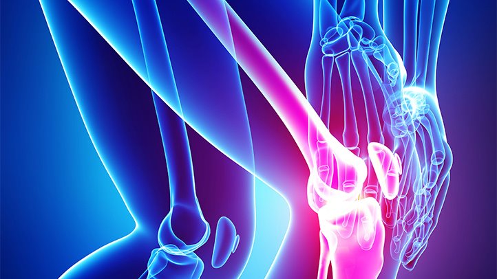 Teknologi Injeksi Terbaru untuk Pengobatan Osteoarthritis Lutut