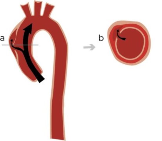 Mengenal Aorta Dissection