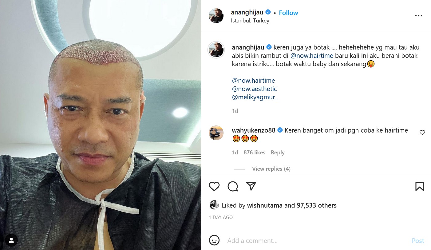 Anang Hermansyah Transplantasi Rambut di Turki, Kevin Aprilio: Mantap Mas