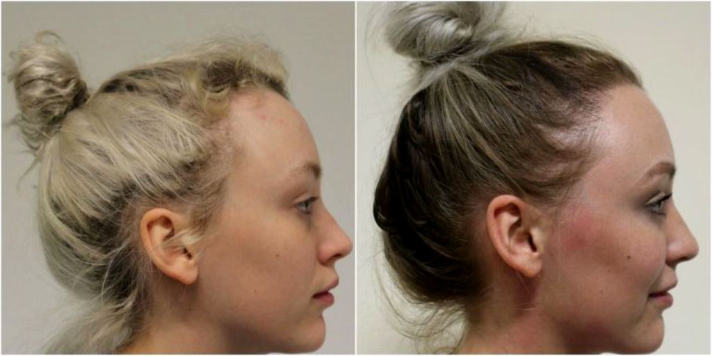 Wanita Ini Alami Traction Alopecia Akibat Menguncir Kencang Rambutnya