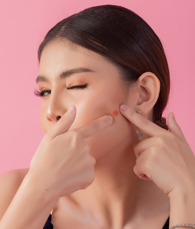 Cara menghilangkan jerawat secara instan. Freepik