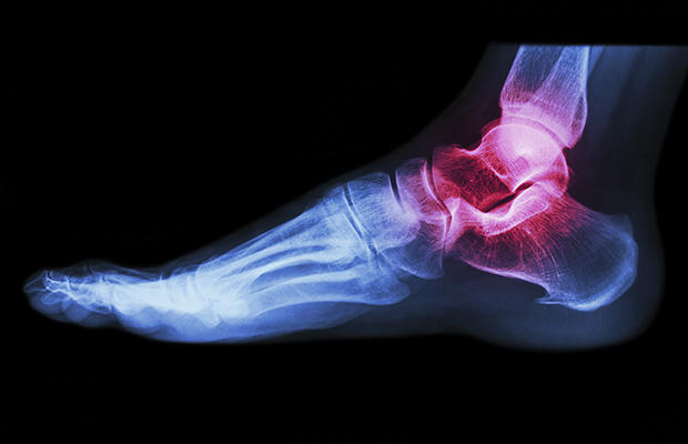 Masalah-Masalah yang Muncul pada Kaki di Usia Tua