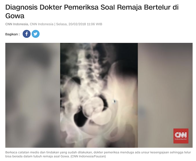 [Cek Fakta] Benarkah Bocah Belasan Tahun di Gowa Sulawesi Selatan Ini Bisa Bertelur? Cek Faktanya