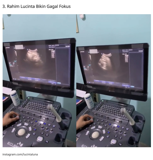 [Cek Fakta] Beredar Foto Hasil USG Lucinta Luna? Ini Faktanya
