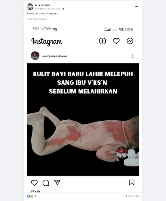 [Cek Fakta] Kulit Bayi Baru Lahir Melapuh karena Sang Ibu Divaksin Covid-19 Saat Hamil? Cek Dulu Faktanya