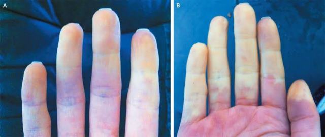 Gejala Sindrom Raynaud yang Menyerang Jari Tangan dan Kaki