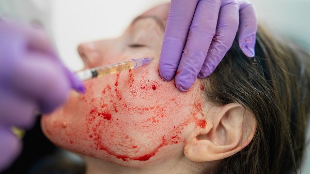 Bahaya di Balik Perawatan Facial Vampir